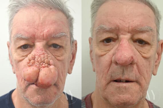 Rhinophyma before and after photos in Princeton, NJ, Patient 1952