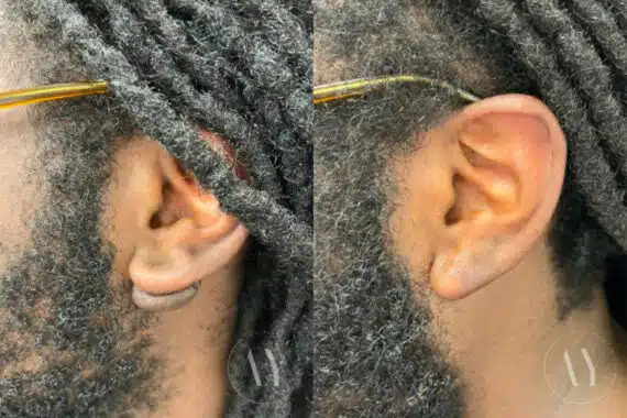 Scar Revision before and after photos in Princeton, NJ