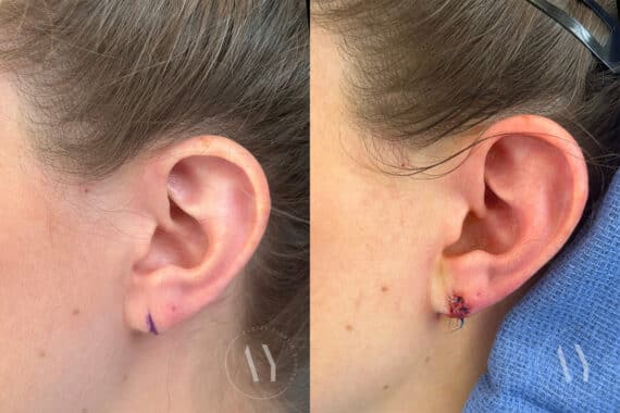 Earlobe Repair before and after photos in Princeton, NJ, Patient 1972
