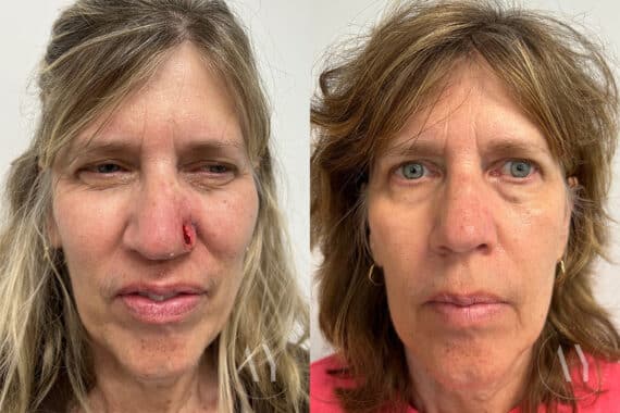 Mohs Reconstruction before and after photos in Princeton, NJ, Patient 1974