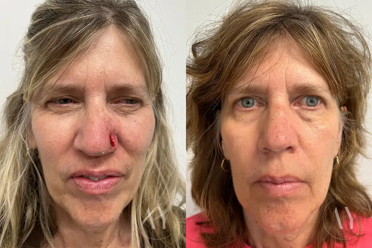 Patient 1974, Mohs Reconstruction before and after photos Mohs Reconstruction before and after photos in Princeton, NJ, Patient 1974