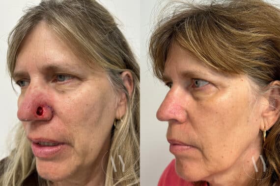 Mohs Reconstruction before and after photos in Princeton, NJ, Patient 1974