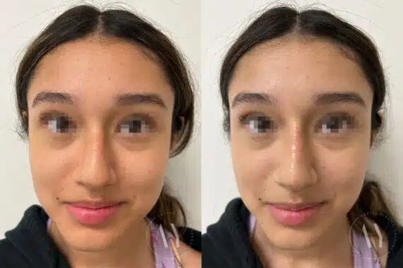 Liquid Rhinoplasty before and after photos in Princeton, NJ