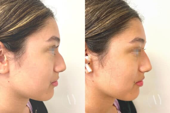 Liquid Rhinoplasty before and after photos in Princeton, NJ, Patient 640