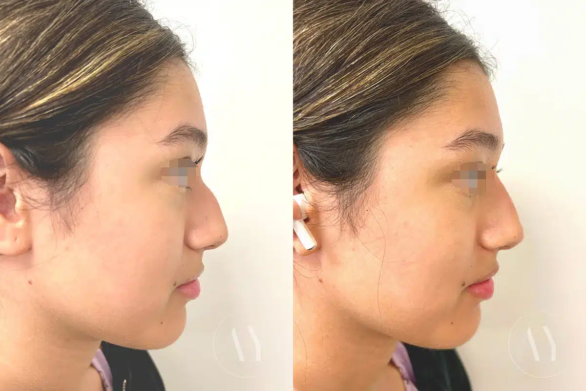 Patient 640, Liquid Rhinoplasty before and after photos Liquid Rhinoplasty before and after photos in Princeton, NJ, Patient 640