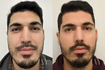 Revision Rhinoplasy before and after photos in Princeton, NJ, Patient 647