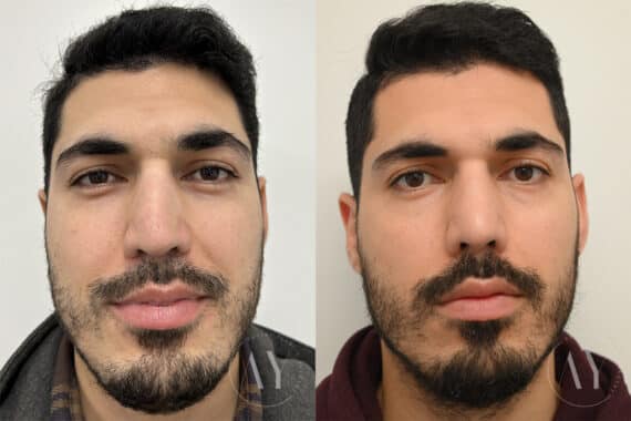 Revision Rhinoplasy before and after photos in Princeton, NJ, Patient 647