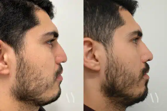 Revision Rhinoplasy before and after photos in Princeton, NJ, Patient 647