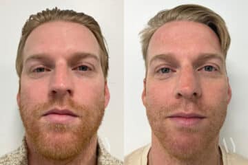 Rhinoplasty before and after photos in Princeton, NJ, Patient 655
