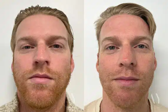 Rhinoplasty before and after photos in Princeton, NJ, Patient 655