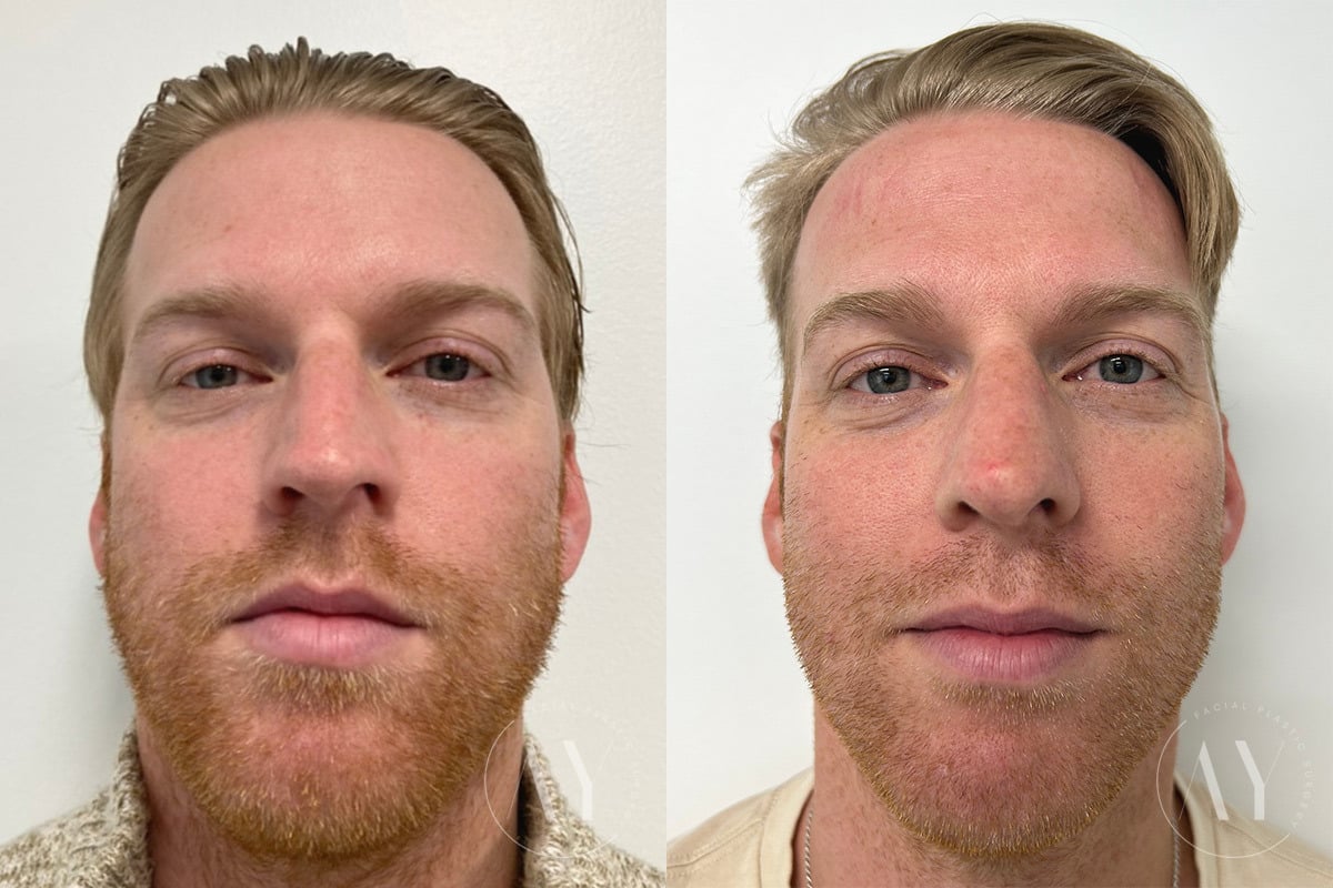 Patient 655, Rhinoplasty before and after photos Rhinoplasty before and after photos in Princeton, NJ, Patient 655