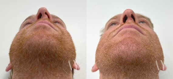 Rhinoplasty before and after photos in Princeton, NJ, Patient 655