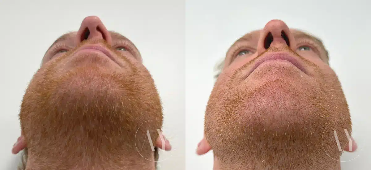 Patient 655, Rhinoplasty before and after photos Rhinoplasty before and after photos in Princeton, NJ, Patient 655