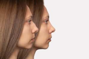Rhinoplasty for breathing helps correct structural issues like a deviated septum, which can significantly improve airflow through the nasal passages.