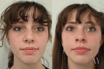 Nasal Trauma before and after photos in Princeton, NJ, Patient 1955