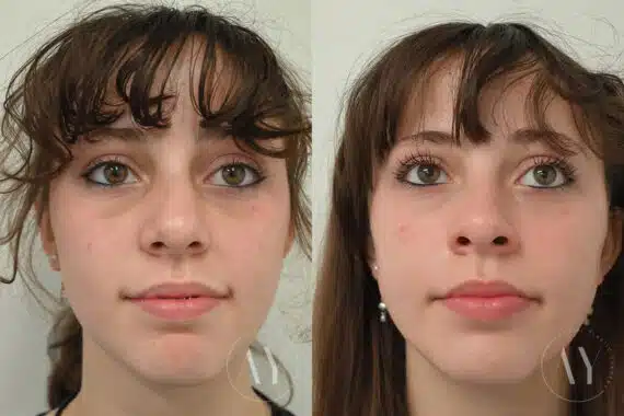Nasal Trauma before and after photos in Princeton, NJ