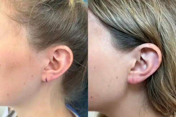 Earlobe Repair before and after photos in Princeton, NJ