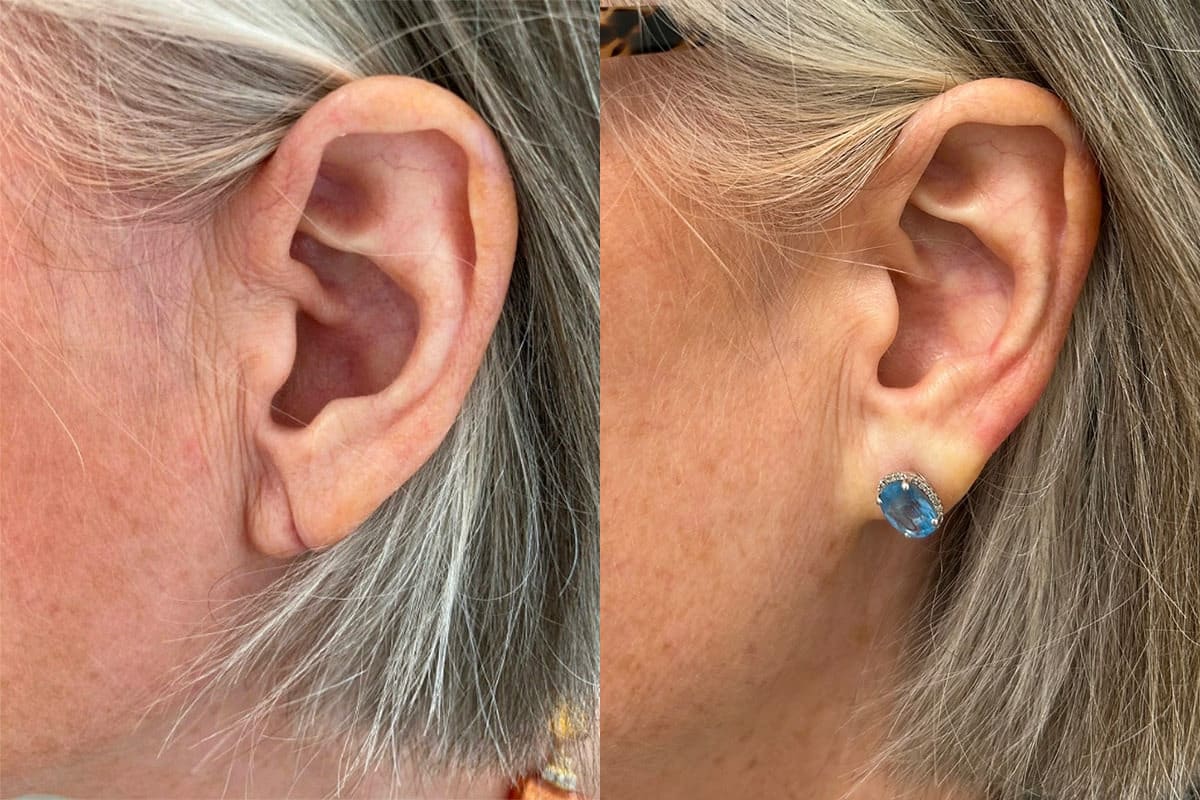 Earlobe Repair before and after photos in Princeton, NJ, Patient 4891