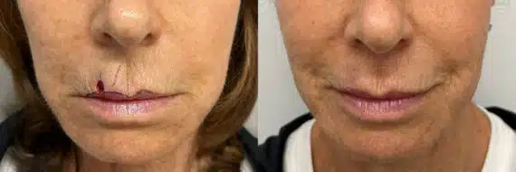 Mohs Reconstruction before and after photos in Princeton, NJ, Patient 4893