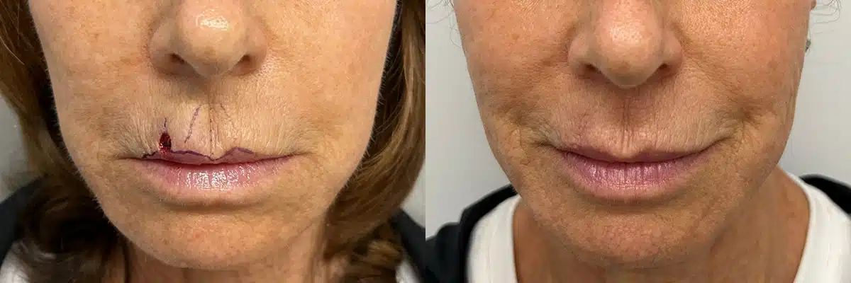 Patient 4893, Mohs Reconstruction before and after photos Mohs Reconstruction before and after photos in Princeton, NJ, Patient 4893
