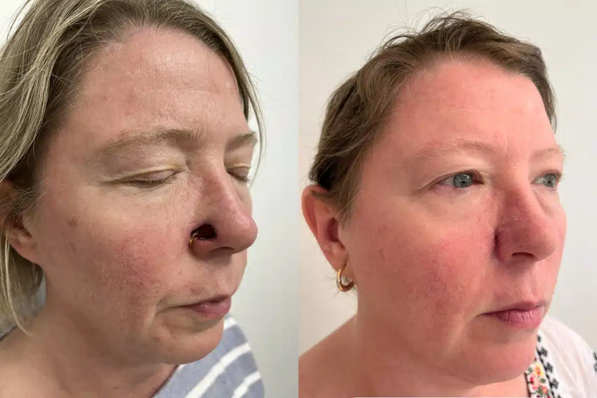 Patient 4895, Mohs Reconstruction before and after photos Mohs Reconstruction before and after photos in Princeton, NJ, Patient 4895