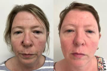 Mohs Reconstruction before and after photos in Princeton, NJ, Patient 4895