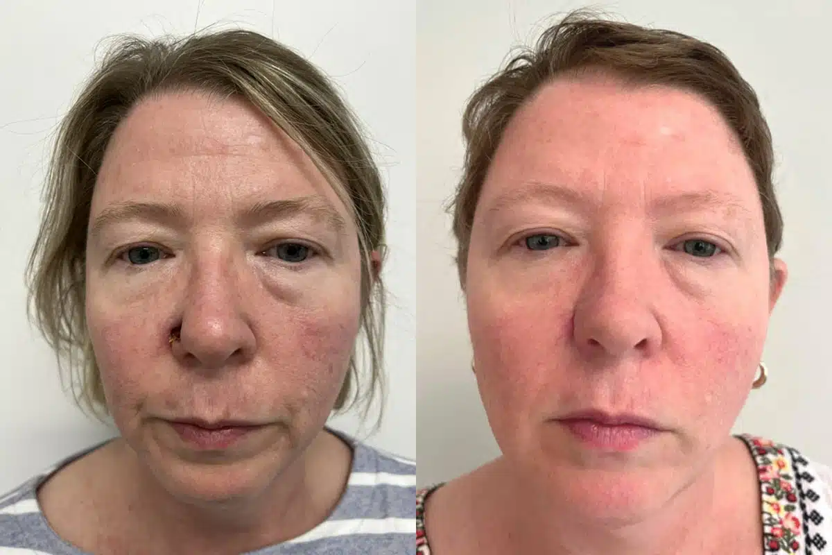 Patient 4895, Mohs Reconstruction before and after photos Mohs Reconstruction before and after photos in Princeton, NJ, Patient 4895