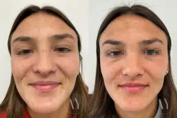 Revision Rhinoplasy before and after photos in Princeton, NJ, Patient 4900