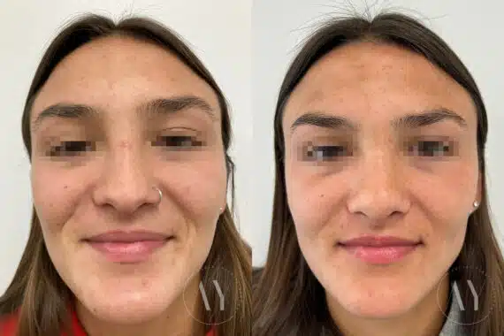 Revision Rhinoplasy before and after photos in Princeton, NJ