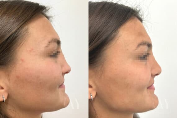 Revision Rhinoplasy before and after photos in Princeton, NJ, Patient 4900