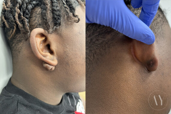 Scar Revision before and after photos in Princeton, NJ, Patient 6090