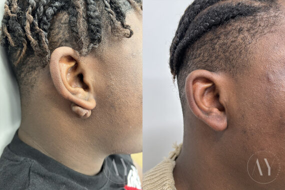 Scar Revision before and after photos in Princeton, NJ