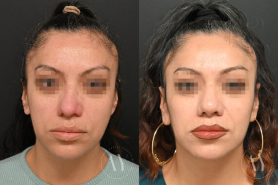 Revision Rhinoplasy before and after photos in Princeton, NJ