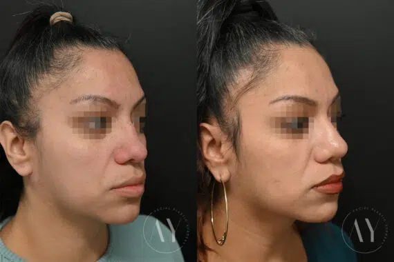 Revision Rhinoplasy before and after photos in Princeton, NJ, Patient 6096