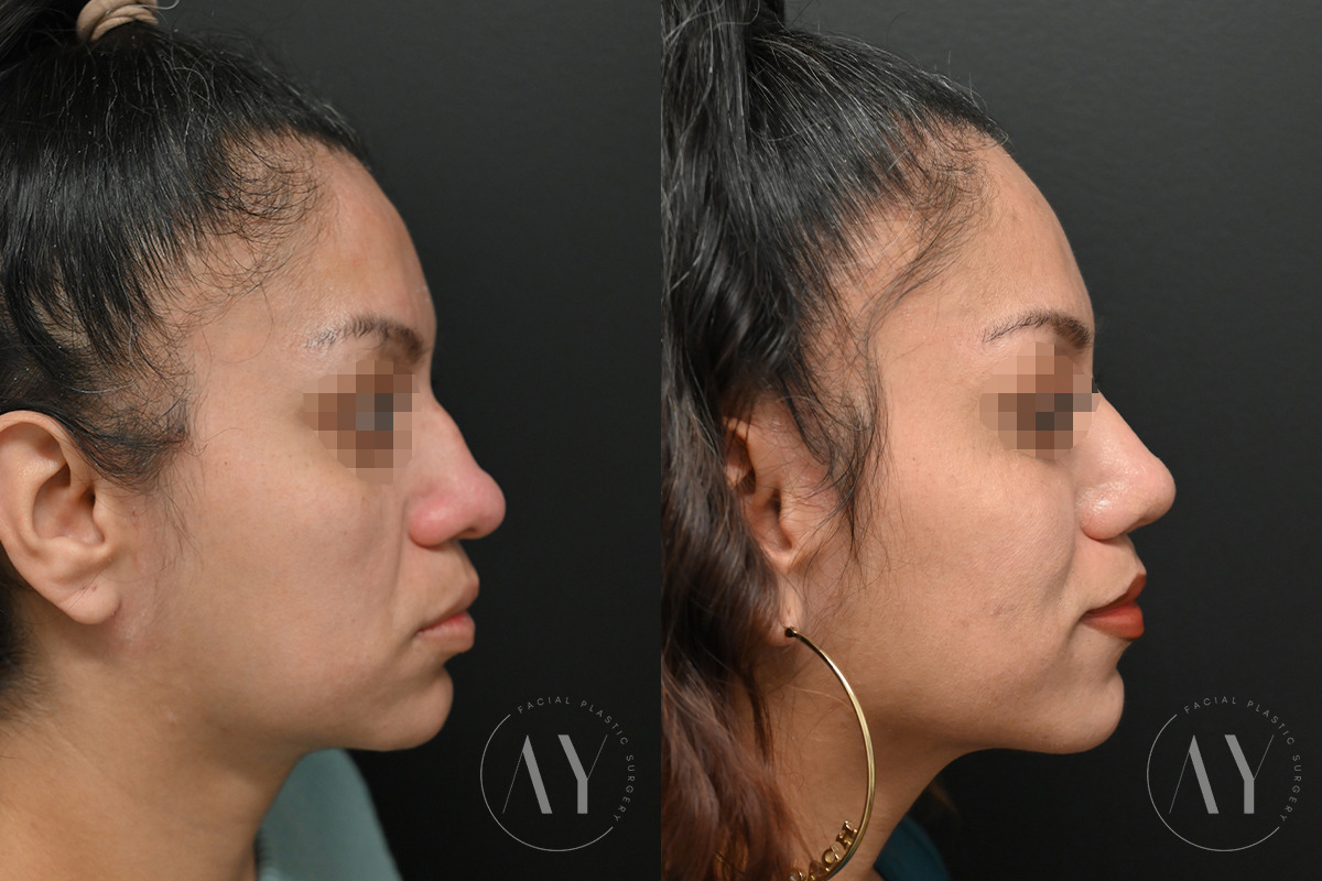Patient 6096, Revision Rhinoplasy before and after photos Revision Rhinoplasy before and after photos in Princeton, NJ, Patient 6096