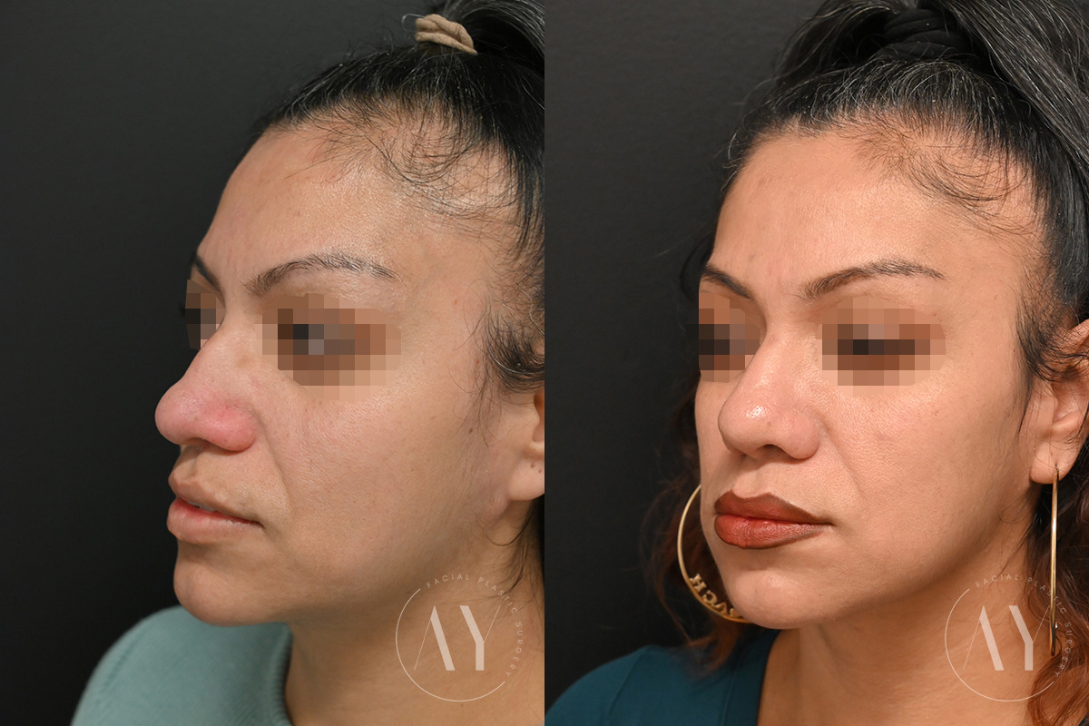 Patient 6096, Revision Rhinoplasy before and after photos Revision Rhinoplasy before and after photos in Princeton, NJ, Patient 6096