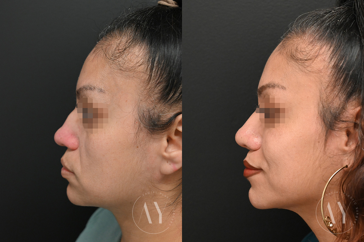 Patient 6096, Revision Rhinoplasy before and after photos Revision Rhinoplasy before and after photos in Princeton, NJ, Patient 6096
