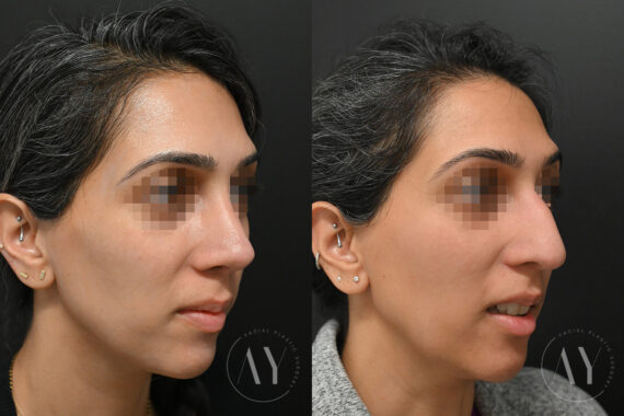 Rhinoplasty before and after photos in Princeton, NJ, Patient 6112