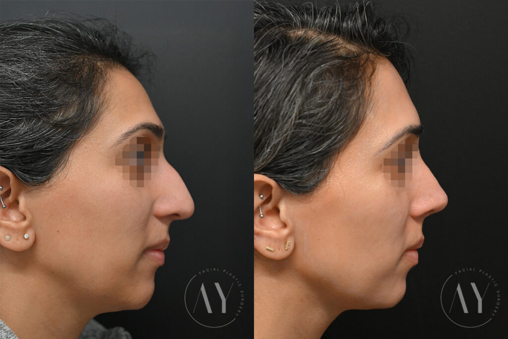 Open vs Closed Rhinoplasty Explained