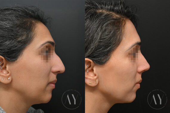 Rhinoplasty before and after photos in Princeton, NJ, Patient 6112