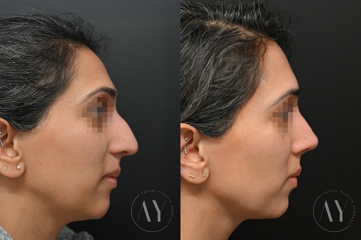 Rhinoplasty before and after photos in Princeton, NJ, Patient 6112