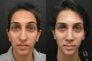 Rhinoplasty before and after photos in Princeton, NJ, Patient 6112