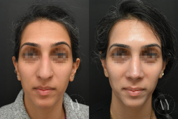 Rhinoplasty before and after photos in Princeton, NJ