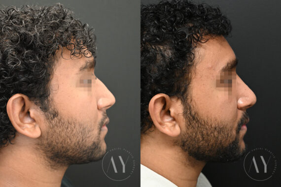 Rhinoplasty before and after photos in Princeton, NJ, Patient 6122