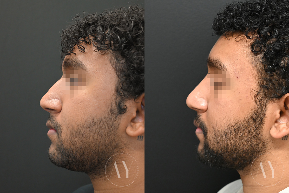 Patient 6122, Rhinoplasty before and after photos Rhinoplasty before and after photos in Princeton, NJ, Patient 6122
