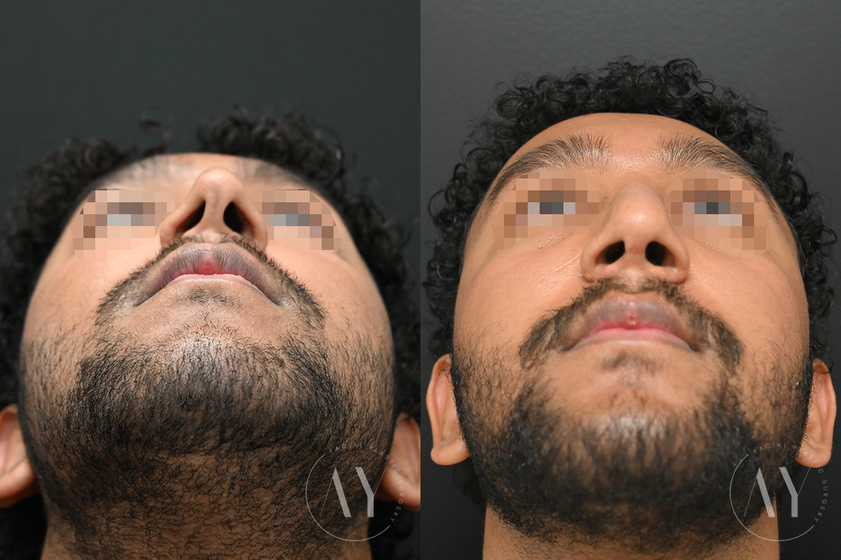 Patient 6122, Rhinoplasty before and after photos Rhinoplasty before and after photos in Princeton, NJ, Patient 6122
