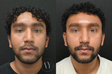 Rhinoplasty before and after photos in Princeton, NJ, Patient 6122