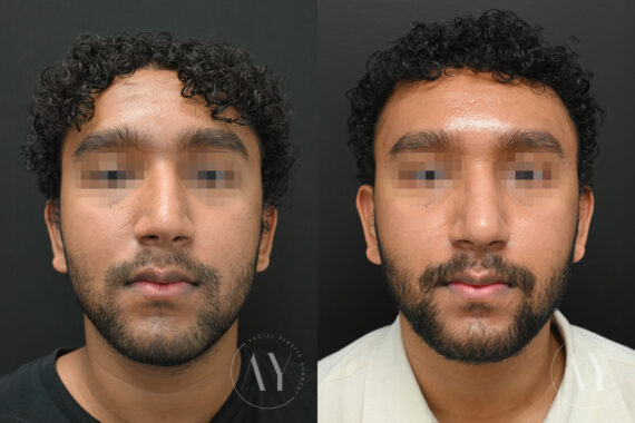 Rhinoplasty before and after photos in Princeton, NJ