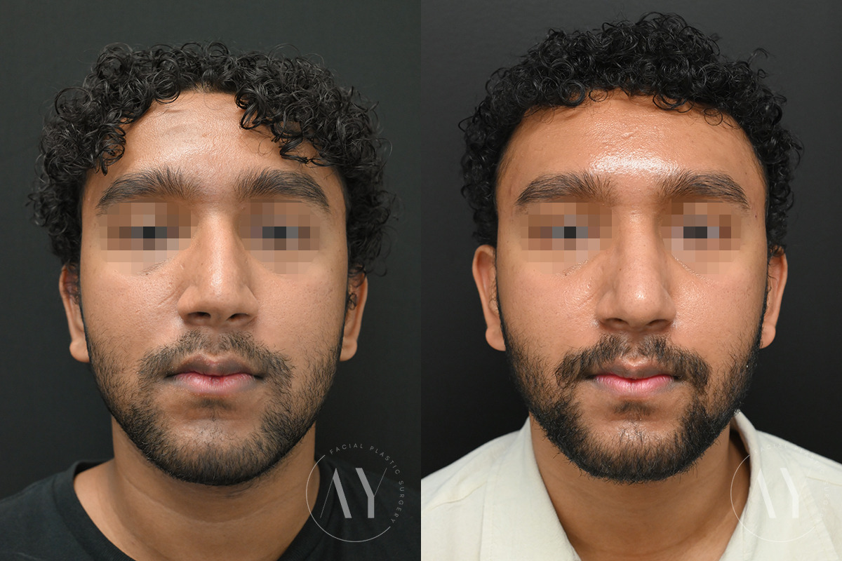 Patient 6122, Rhinoplasty before and after photos Rhinoplasty before and after photos in Princeton, NJ, Patient 6122