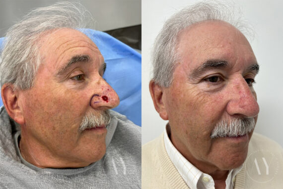 Mohs Reconstruction before and after photos in Princeton, NJ